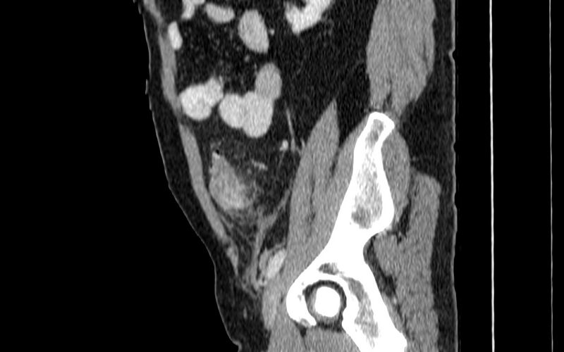 File:Acute sigmoid colon diverticulitis (Radiopaedia 55507-61976 Sagittal C+ portal venous phase 75).jpg