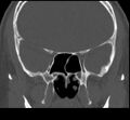 Acute sinusitis (Radiopaedia 23161-23215 Coronal bone window 46).jpg