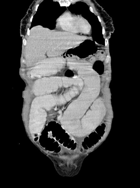 File:Acute small bowel (ileal) volvulus (Radiopaedia 71740-82139 Coronal C+ portal venous phase 24).jpg