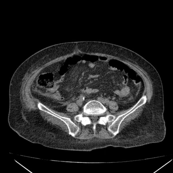 File:Acute tubular necrosis (Radiopaedia 28077-28334 Axial non-contrast 46).jpg
