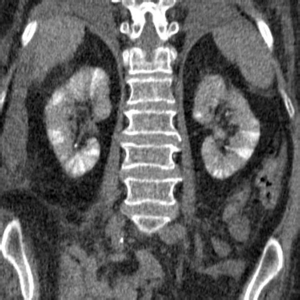 File:Acute tubular necrosis (Radiopaedia 28077-28334 Coronal non-contrast 19).jpg