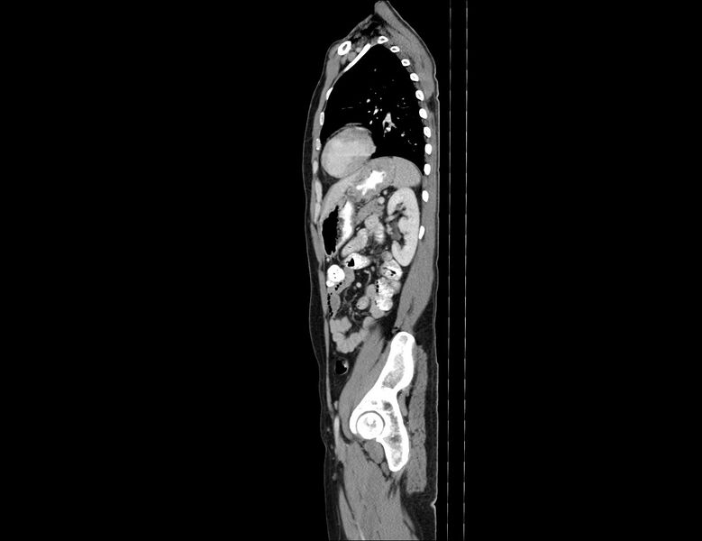 File:Addison disease (Radiopaedia 49318-54412 Sagittal C+ portal venous phase 20).jpg