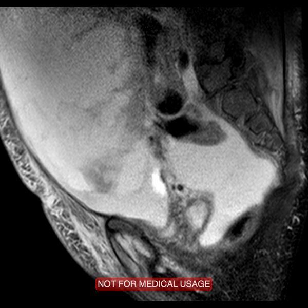 File:Adenocarcinoma of the cervix (Radiopaedia 28373-28615 Sagittal T2 fat sat 5).jpg