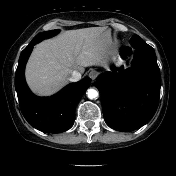 File:Adenocarcinoma of the lung (Radiopaedia 41015-43755 Axial C+ portal venous phase 103).jpg