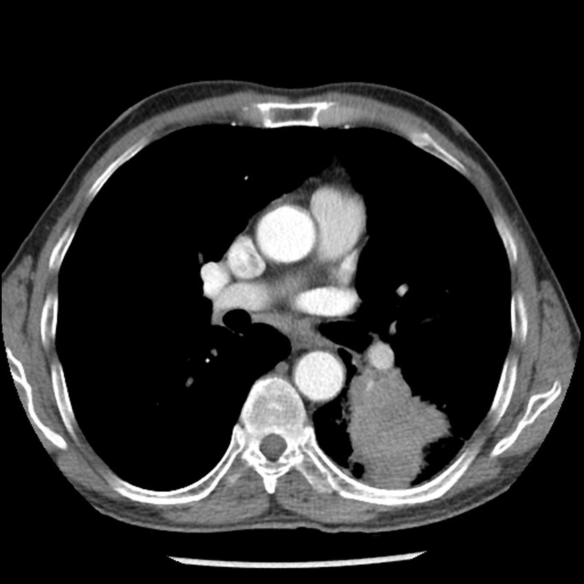 Adenocarcinoma of the lung - micropapillary predominant (Radiopaedia 42446-45563 Axial C+ portal venous phase 35).jpg