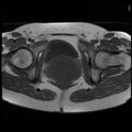 Adenoma malignum of the cervix (Radiopaedia 24460-24765 T1 15).jpg
