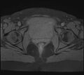Adenomyosis - ovarian endometriomas (Radiopaedia 67031-76350 Axial T1 fat sat 22).jpg