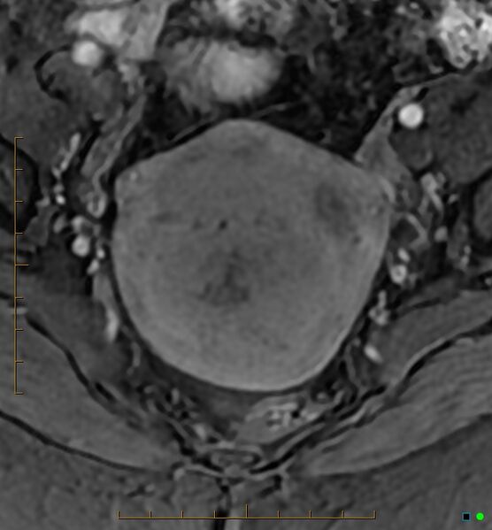 File:Adenomyosis uterus with hematometra (Radiopaedia 45779-50011 Axial T1 C+ fat sat 22).jpg