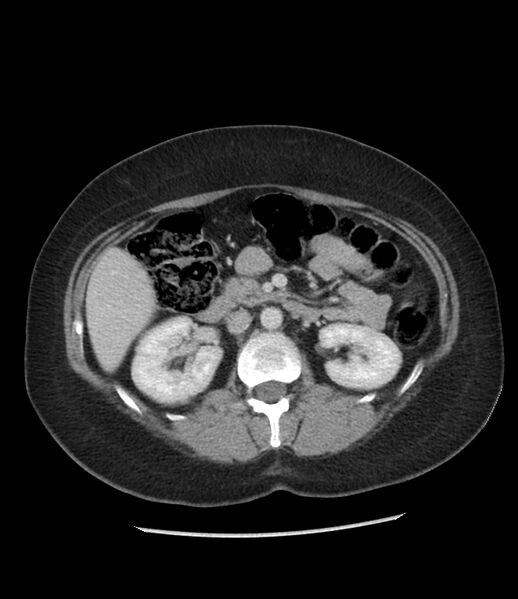 File:Adrenal cortical carcinoma with IVC invasion and thrombosis (Radiopaedia 34307-35597 Axial C+ portal venous phase 37).jpg