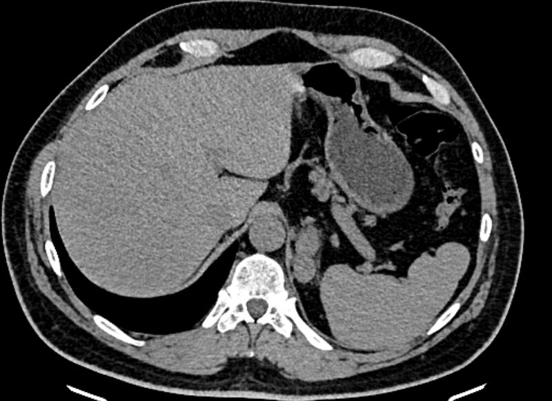 File:Adrenal metastases (Radiopaedia 73082-83791 Axial non-contrast 34).jpg