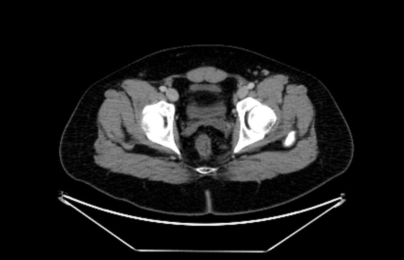 File:Adrenocortical carcinoma (Radiopaedia 80134-93438 Axial C+ portal venous phase 124).jpg