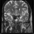 Amnestic syndrome secondary to hypoxic brain injury (Radiopaedia 24743-25004 F 15).jpg