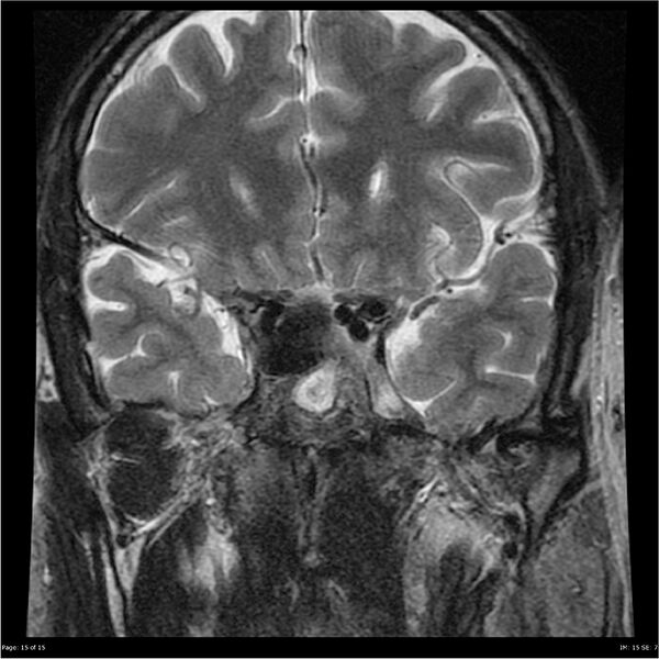 File:Amnestic syndrome secondary to hypoxic brain injury (Radiopaedia 24743-25004 F 15).jpg