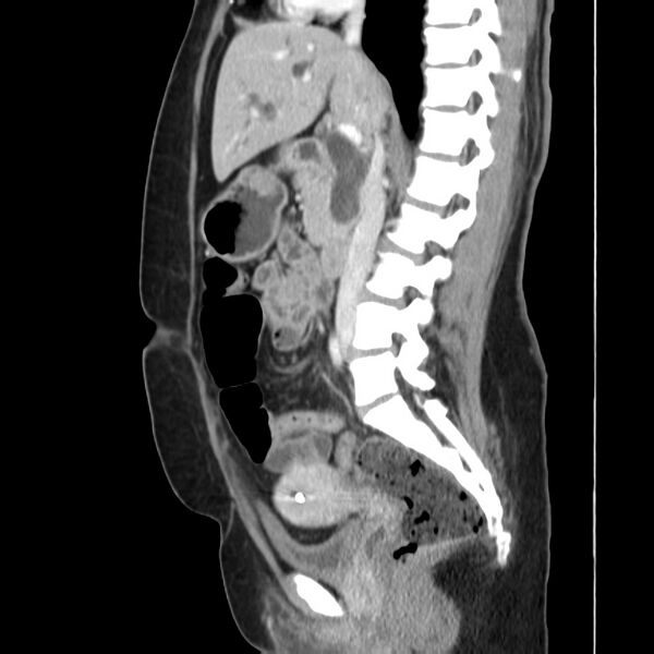 File:Ampullary tumor (Radiopaedia 22787-22816 D 27).jpg