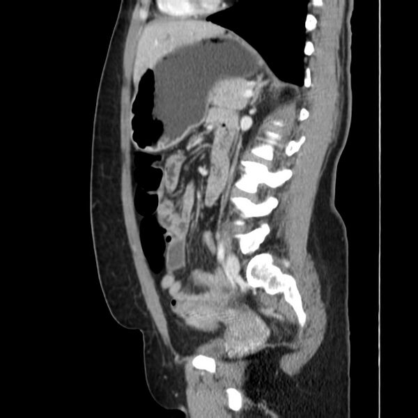 File:Ampullary tumor (Radiopaedia 22787-22816 D 34).jpg