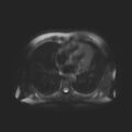 Ampullary tumor (Radiopaedia 27294-27479 T2 SPAIR 22).jpg