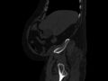 Ankylosing spondylitis (Radiopaedia 44609-48357 Sagittal bone window 14).jpg