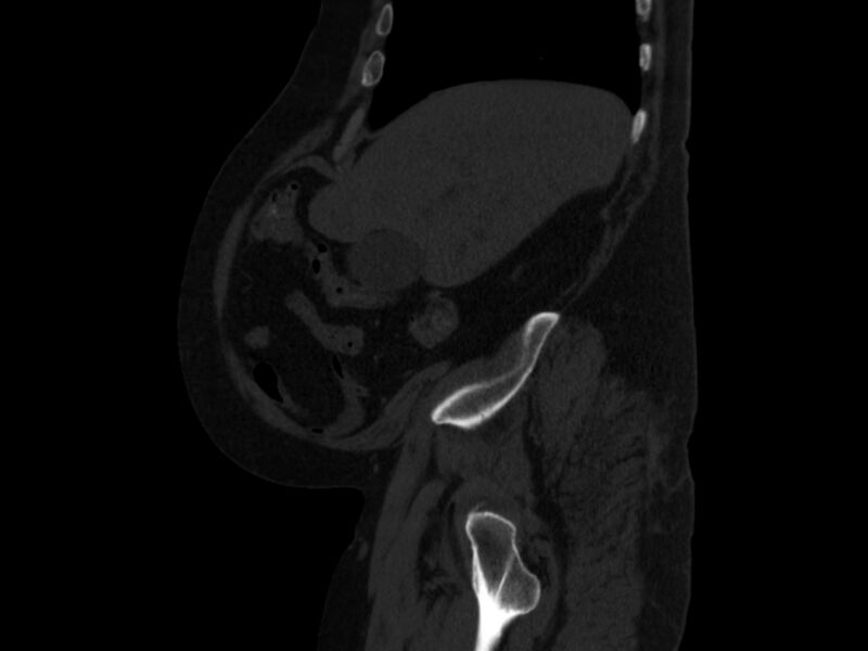 File:Ankylosing spondylitis (Radiopaedia 44609-48357 Sagittal bone window 14).jpg