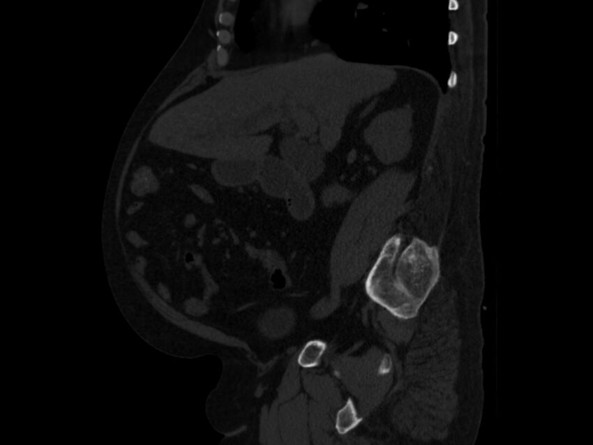 Ankylosing spondylitis (Radiopaedia 44609-48357 Sagittal bone window 36).jpg