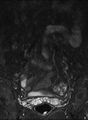 Ankylosing spondylitis - Andersson lesion (Radiopaedia 81878-95838 Coronal STIR 1).jpg