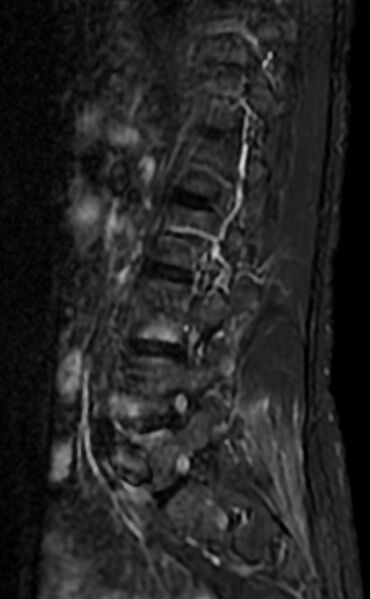 File:Ankylosing spondylitis - Andersson lesion (Radiopaedia 81878-95838 Sagittal STIR 10).jpg