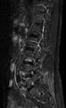 Ankylosing spondylitis - Andersson lesion (Radiopaedia 81878-95838 Sagittal STIR 10).jpg