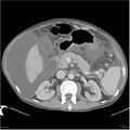 Annular pancreas and cirrhosis (Radiopaedia 24561-24843 A 7).jpg
