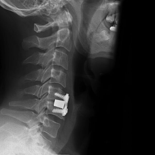 File:Anterior cervical discectomy and fusion (ACDF) subsidence (Radiopaedia 7196-72300 Lateral 1).jpg