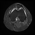 Anterior cruciate ligament tear, Wrisberg rip and bucket-handle tear of medial meniscus (Radiopaedia 75872-87266 Axial PD fat sat 16).jpg