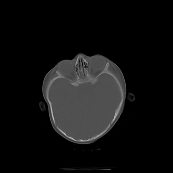 File:Anterior plagiocephaly (Radiopaedia 71836-82273 Axial bone window 6).jpg