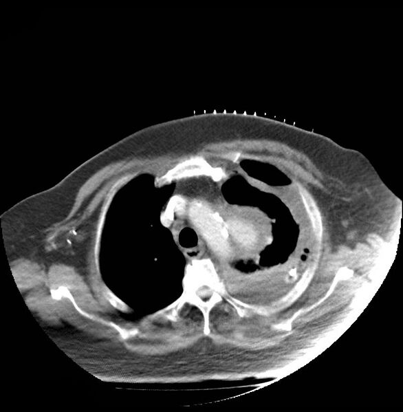 File:Aortic arch false aneurysm (Radiopaedia 14667-14588 A 4).jpg