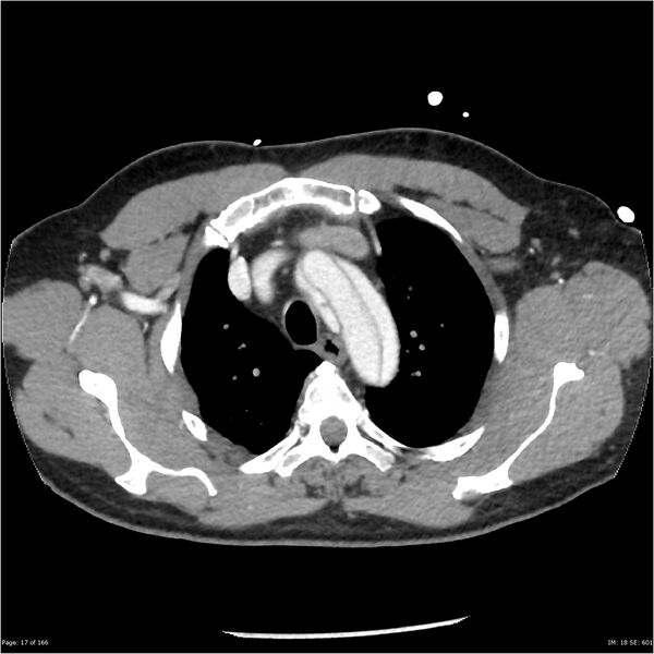 File:Aortic dissection- Stanford A (Radiopaedia 37759-39664 A 8).jpg