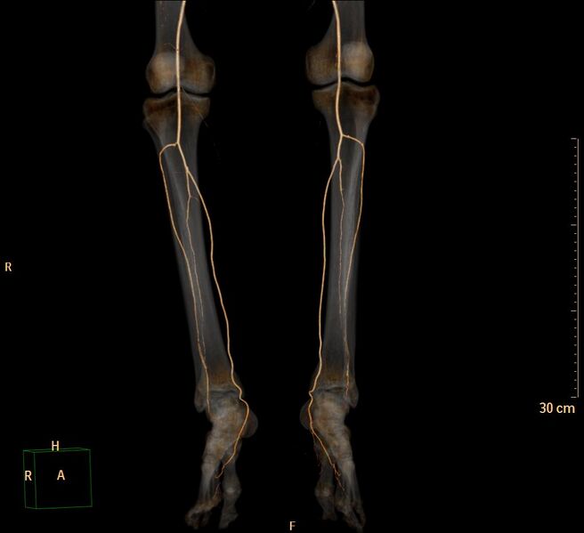 File:Aortoiliac occlusive disease (Radiopaedia 31376-32161 3D-VR Leg arteries 1).jpg