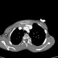 Aortopulmonary window, interrupted aortic arch and large PDA giving the descending aorta (Radiopaedia 35573-37074 B 19).jpg