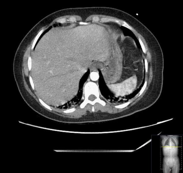 File:Appendicitis (CT angiogram) (Radiopaedia 154713-127660 Axial 169).jpg