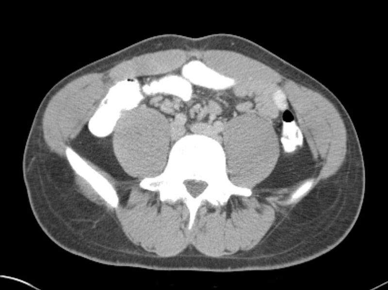 File:Appendicitis and incidental foregut duplication cyst (Radiopaedia 52962-58916 A 55).jpg