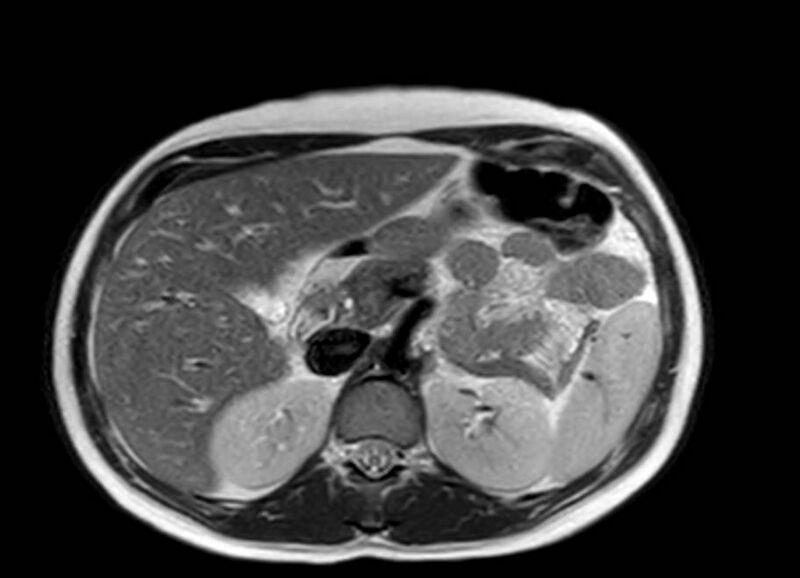 File:Appendicitis in gravida (MRI) (Radiopaedia 89433-106395 Axial T2 18).jpg
