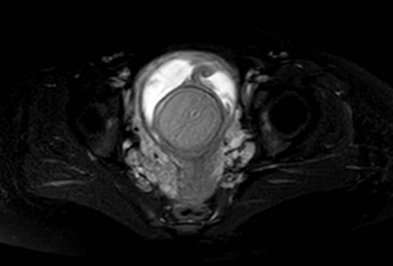 File:Appendicitis in gravida (MRI) (Radiopaedia 89433-106395 Axial T2 SPAIR 68).jpg