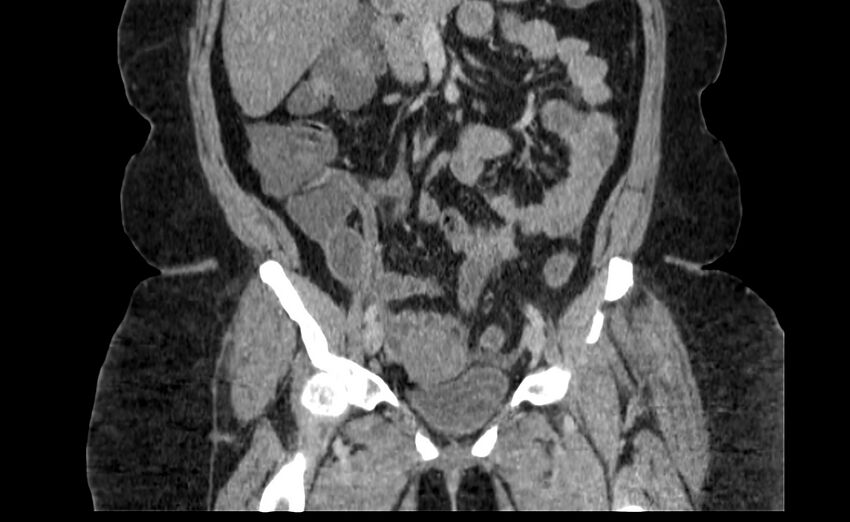 Appendix mucocele (Radiopaedia 41222-44033 B 33).jpg