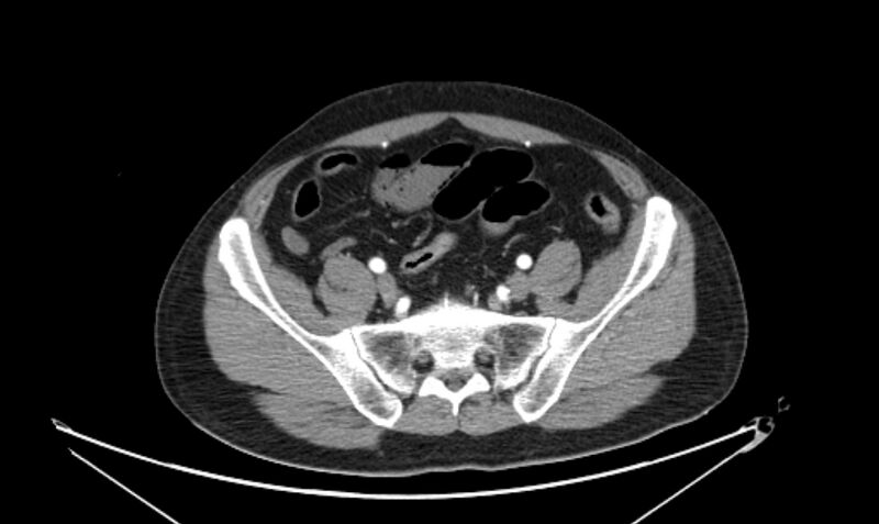 File:Arterial occlusive mesenteric ischemia (Radiopaedia 84641-100060 A 101).jpg
