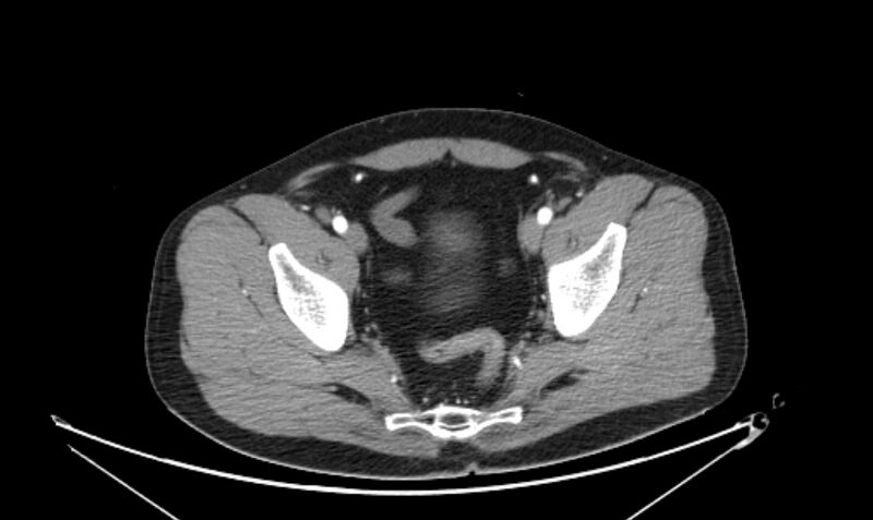 File:Arterial occlusive mesenteric ischemia (Radiopaedia 84641-100060 A 114).jpg