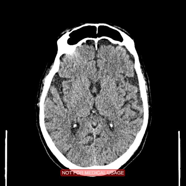 File:Artery of Percheron infarction (Radiopaedia 28679-28967 Axial non-contrast 62).jpg