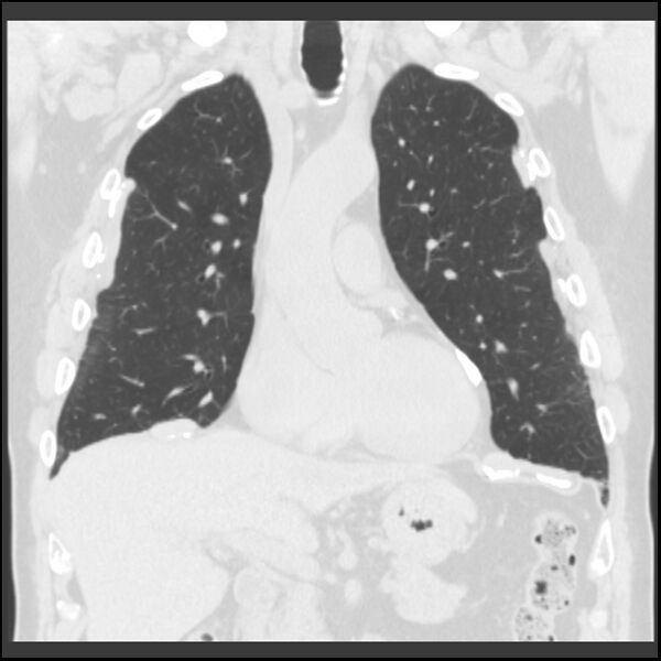 File:Asbestos-related pleural plaques (Radiopaedia 39069-41255 Coronal lung window 56).jpg