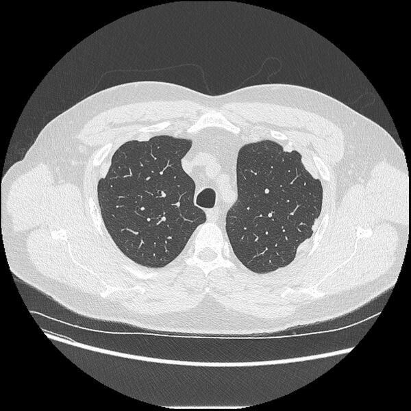 File:Asbestosis (Radiopaedia 45002-48961 Axial lung window 12).jpg