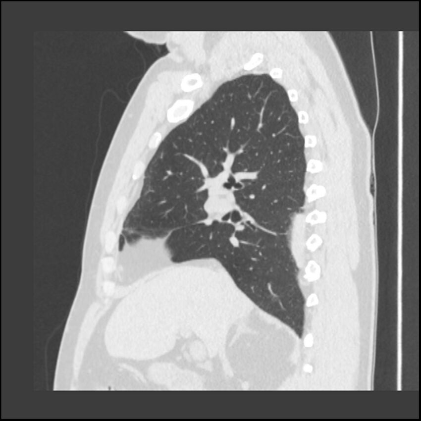 Asbestosis (Radiopaedia 45002-48961 Sagittal lung window 85).jpg