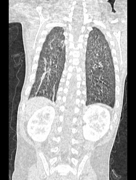 File:Asplenia syndrome (Radiopaedia 73083-83792 Coronal lung window 112).jpg