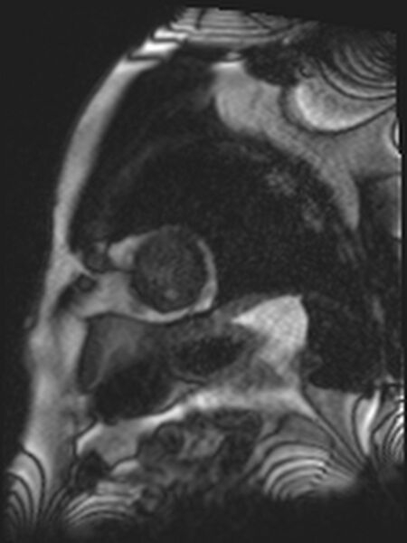 File:Asymmetric septal hypertrophic cardiomyopathy - systolic anterior motion of mitral leaflet (Radiopaedia 72795-83445 E 9).jpg