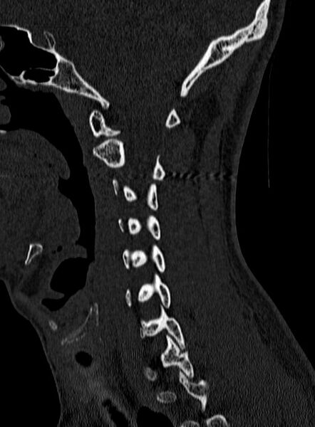 File:Atlantoaxial subluxation (Radiopaedia 44681-48450 Sagittal bone window 36).jpg