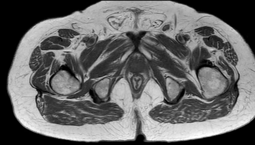 Atypical lipomatous tumor - thigh (Radiopaedia 68975-78734 Axial T1 85).jpg