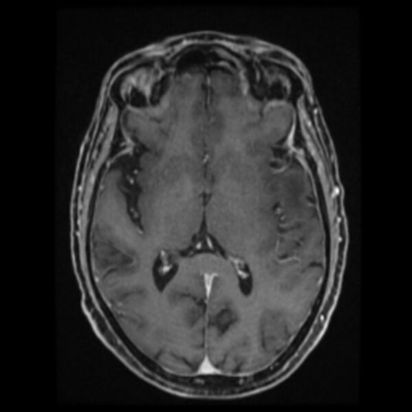 File:Atypical meningioma (Radiopaedia 45535-49629 Axial T1 C+ 38).jpg